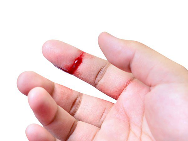 Nằm mơ thấy bị thương đem lại ý nghĩa gì đặc biệt Nằm mơ thấy bị thương đem lại ý nghĩa gì đặc biệt