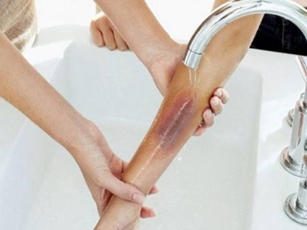 Thấy bị bỏng nước sôi xuất hiện bộ số may mắn nào