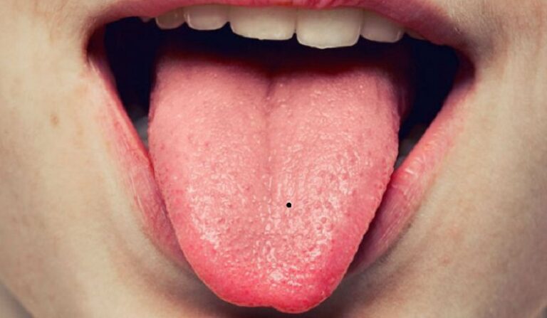Ý nghĩa nốt ruồi ở giữa lưỡi